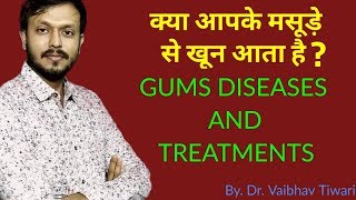 मसूड़े की बीमारी एवं उपचार  Gingivitis  perodontitis pyorrhea in hindi [upl. by Daron]