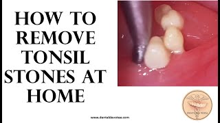 How to remove tonsil stones at home  Tonsil stone removal [upl. by Selene]