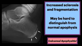 Calcaneal Apophysitis MSK Radiology Orthopedics [upl. by Sherwood306]