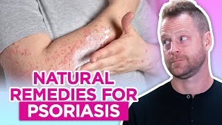 How to Get Rid of Psoriasis – Natural Remedies for Psoriasis [upl. by Cardon54]