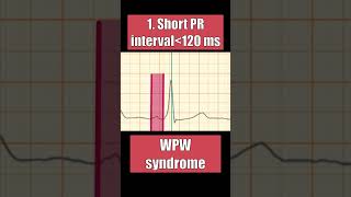 PR INTERVAL normal in AV block WPW pericarditis and atrial ischemia [upl. by Hui]