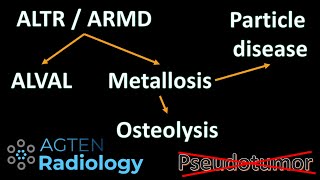 Hip Metallosis Pseudotumor ALVAL or ALTR or ARMD [upl. by Philipa]