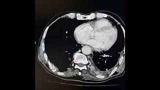 Adenocarcinoma of left lung with extrathoracic and intraspinal extension [upl. by Ernie39]