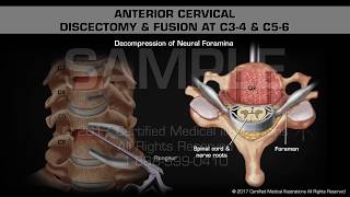 Anterior Cervical Discectomy amp Fusion at C34 amp C56 [upl. by Fedirko]