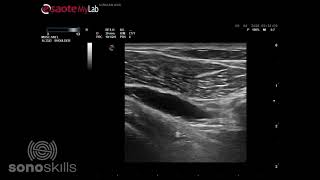 Subcoracoid bursitis during active external internal rotation [upl. by Negeam]