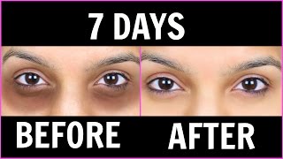 Remove Dark Circles काले घेरों  6 Magical Remedies 100 Effective Anaysa [upl. by Ecinwahs]