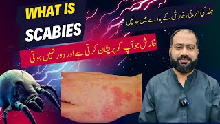 Scabies in Urdu  Kharish Ka ilaj  Skin allergy ka ilaj  Skin itching [upl. by Emmeline]