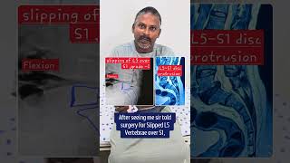 Patient Testimonial  Spinal Fixation Surgery For Slipping of L5 Vertebrae Over S1  Dr Ravi Kumar [upl. by Janenna]