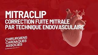 Mitraclip  Correction fuite mitrale par technique endovasculaire [upl. by Ennahgem]