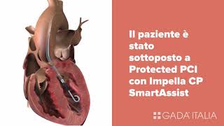 Abiomed Impella CP SmartAssist  Primo impianto in Italia [upl. by Odelinda]