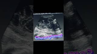 Placenta Mass  Chorangioma  Normal Fetal Scan  Anomaly Ultrasound [upl. by Esetal]