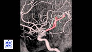 Interventional Stroke Rounds  Stroke Reversal with Penumbra [upl. by Lorsung]