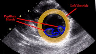 Papillary Muscle  Parasternal Short Axis [upl. by Akiehs]