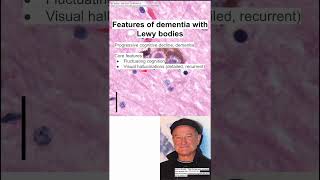 Features of dementia with Lewy bodies [upl. by Yvon541]