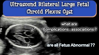 Ultrasound Bilateral Large Fetal Chroid Plexus Cyst  Associations [upl. by Nothgierc363]