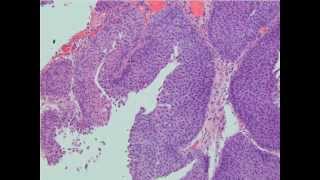 Urothelial Carcinoma [upl. by Ahslek]