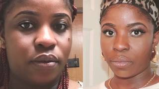 How To Remove Skin Tag on Face Fast at home In 5 Days [upl. by Oirifrop]