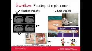 Duchenne Pulmonary Care for Adults Webinar November 2014 [upl. by Minta]