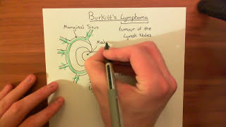 Burkitts Lymphoma Part 1 [upl. by Barrie]