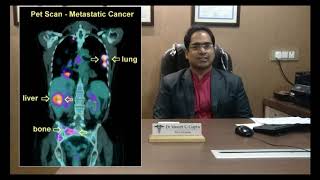 हड्डी में सूजन हड्डी का कैंसर हो सकता है  Bone cancer osteosarcoma ewing sarcoma hindi video [upl. by Enelie]