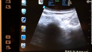 ultrasound guided bilateral SI joint injection  sacroilliac joint injection [upl. by Ahtimat]