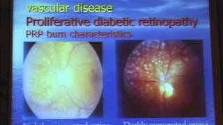 Uses of Lasers in Diabetic Retinopathy [upl. by Yniatirb]