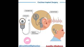 Hearing Aids Types Of HILaxika Shokeen shorts specialeducation education hearing short [upl. by Daffy]