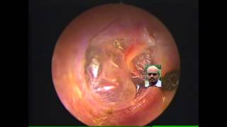 Retracted ear drum seen bulging on valsalva [upl. by Mycah]