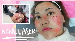 Painful ACNE LASER Experience in Korea [upl. by Llenahs404]