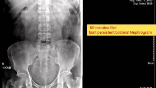 CASE 109 IVP bilateral Delayed faint persistent nephrogram [upl. by Elleniad]