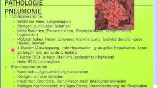 Gratis Seminar Pneumonien  Typische  atypische Pneumonien [upl. by Hawger]