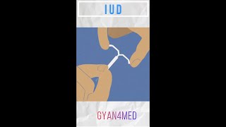 What is an IUD [upl. by Ayotal]