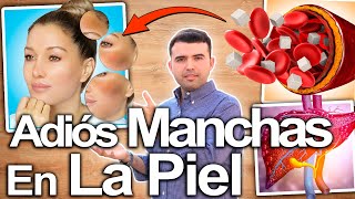 ACLARA TU PIEL AHORA  Cómo Eliminar Las Manchas Oscuras Las Manchas De La Piel Para Siempre [upl. by Tlevesor]