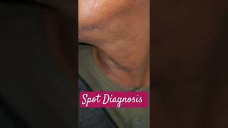 Spot Diagnosis Ear Condition Ear spotdiagnosis Perichondritis [upl. by Anaihs447]