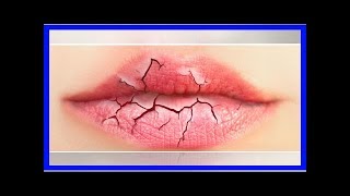 Trockene Lippen und rissige Mundwinkel – das sagen sie über deine Gesundheit aus [upl. by Maddock]