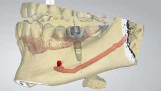 Digital Implant Dentistry [upl. by Esojnauj]