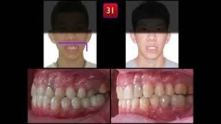 Class III with Unilateral Cross Bite｜【Chris Chang Ortho】CC818 [upl. by Georgiana]