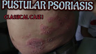 Dermatology  Pustular Psoriasis  Dr Suchana Marahatta  नेपालीमा [upl. by Llennej528]