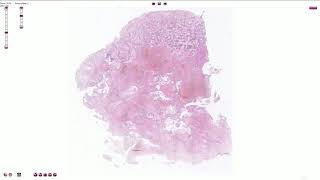 Choriocarcinoma  Histopathology [upl. by Bacon618]