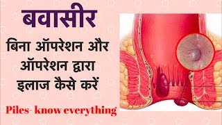 बवासीर  बिना ऑपरेशन और ऑपरेशन द्वारा इलाज कैसे करें  Piles  Hemorrhoids [upl. by Anileba]