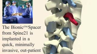 New treatment of Lumbar Spinal Stenosis [upl. by Ttezil664]