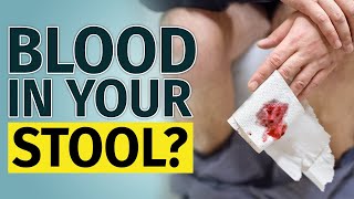 BLOOD IN STOOL  Other Signs You Have to Check [upl. by Jarrad912]