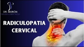 RADICULOPATIA CERVICAL [upl. by Annaoi]