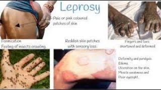 Leprosy  leprosy treatment  Leprosy pathology  hensens disease  leprosy disease [upl. by Chlori]