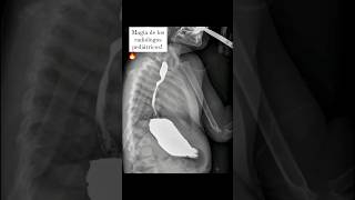 Subclavia derecha aberrante por fluoroscopia ✅ pediatrics pediatria radiology [upl. by Eralcyram]