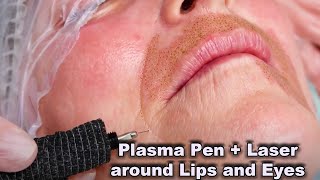 Plasma Pen Fibroblast treatment in combination with Laser for wrinkles around lips and eyelids [upl. by Aset]