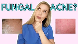 Do YOU have Fungal Acne  Dermatologist Talks Symptoms and Treatments [upl. by Analram]