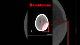 Brain Hematoma CT Brain  EDH  SDH shorts hematoma radiology brainhaemorrhage [upl. by Atnahsal485]