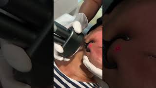 CO2 fractional laser for laser skin resurfacing [upl. by Medora]