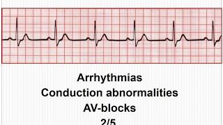 ECG Arrhythmias  AVconduction blocks 25 [upl. by Delcine]